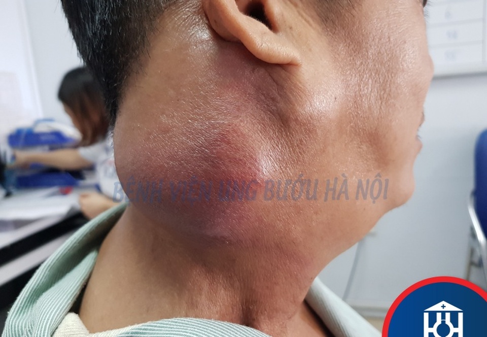 Đắp lá chữa ung thư, khối u càng to nhanh hơn - 1 Đắp lá chữa ung thư, khối u càng to nhanh hơn - 1