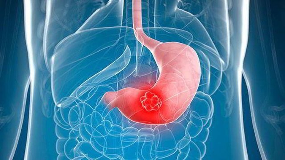 Cô gái 21 tuổi đã bị ung thư, bác sĩ cảnh báo thói quen xấu ở giới trẻ - 3 Cô gái 21 tuổi đã bị ung thư, bác sĩ cảnh báo thói quen xấu ở giới trẻ - 3