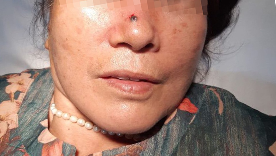 Tưởng nốt ruồi bình thường hóa ung thư da - 1 Tưởng nốt ruồi bình thường hóa ung thư da - 1