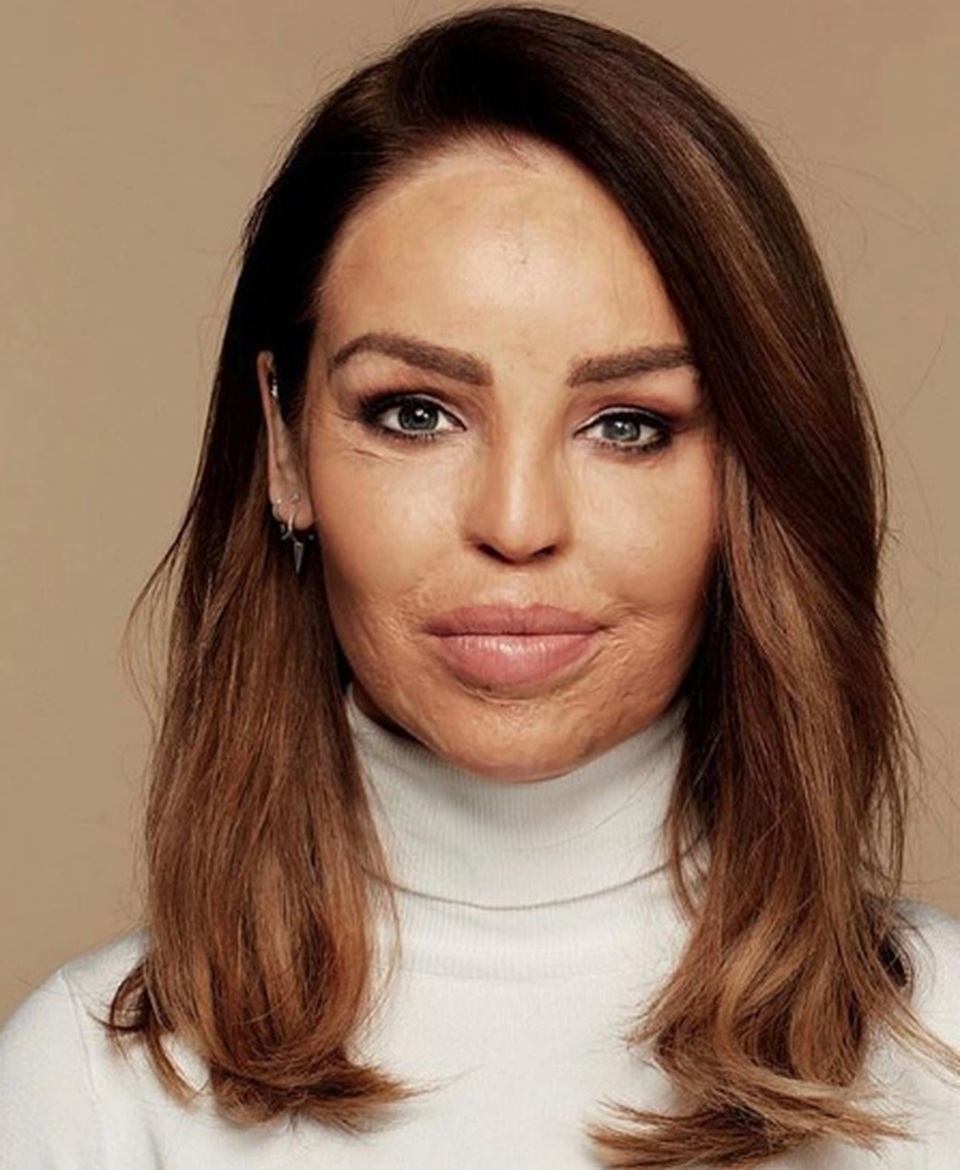 MC truyền hình Katie Piper hé lộ ảnh bị tạt axít - 10