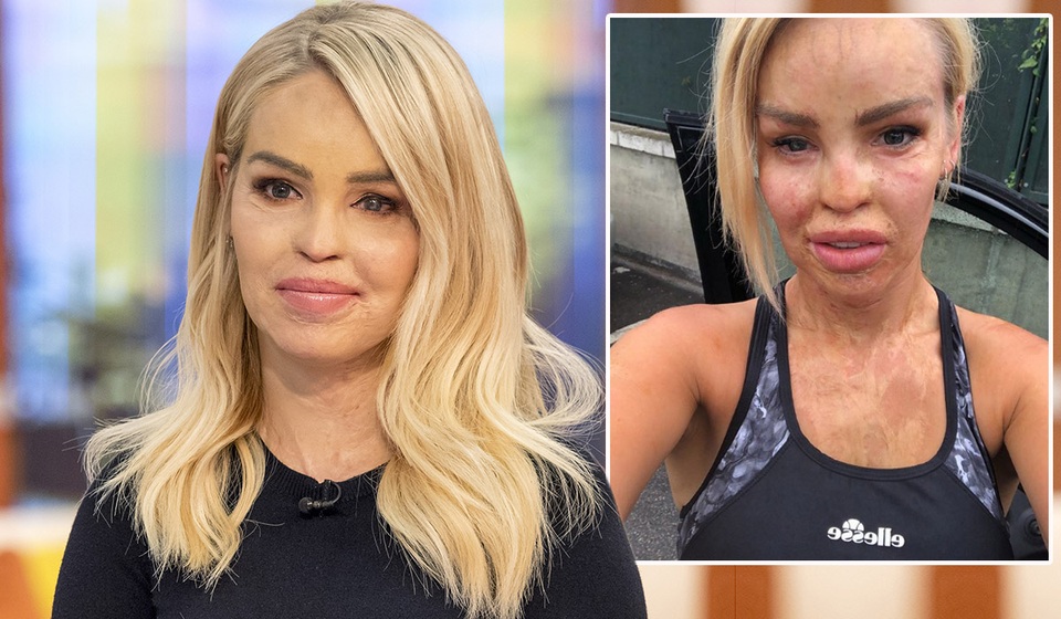 MC truyền hình Katie Piper hé lộ ảnh bị tạt axít - 2