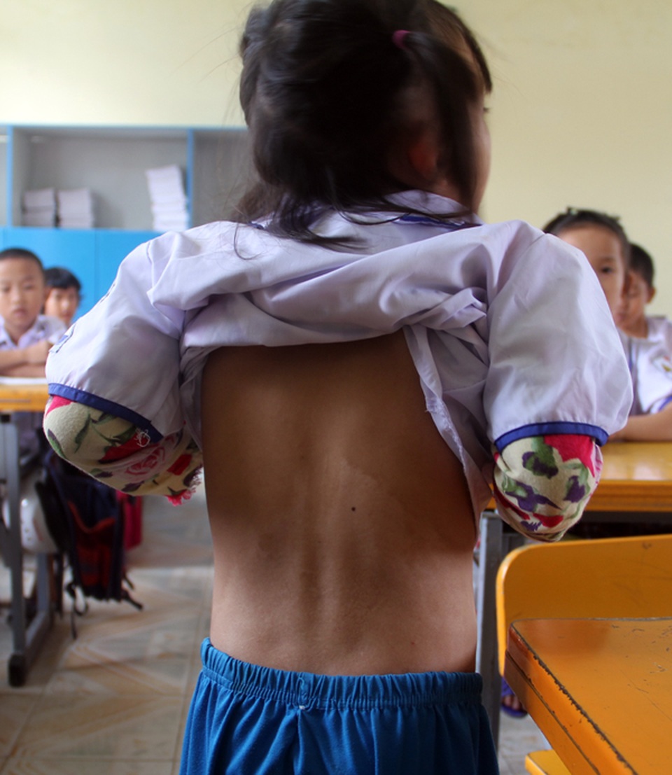 Bé gái 2 tuổi bị nồi canh đang sôi đổ lên người giờ đã bước chân vào lớp một - 6 Bé gái 2 tuổi bị nồi canh đang sôi đổ lên người giờ đã bước chân vào lớp một - 6