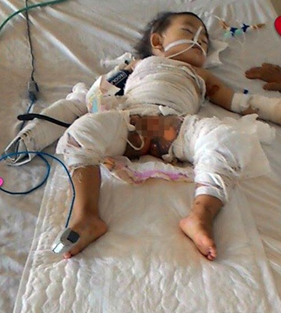 Bé gái 2 tuổi bị nồi canh đang sôi đổ lên người giờ đã bước chân vào lớp một - 2 Bé gái 2 tuổi bị nồi canh đang sôi đổ lên người giờ đã bước chân vào lớp một - 2