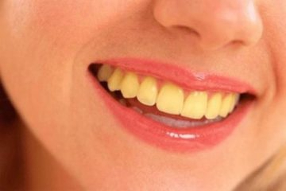 Vết ố cà phê trên răng: nguy cơ và cách giải quyết - 1 Vết ố cà phê trên răng: nguy cơ và cách giải quyết - 1