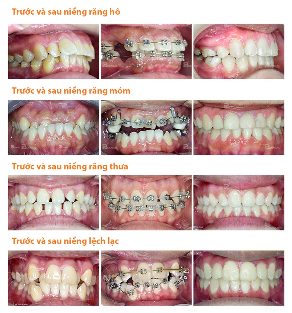 Thời gian niềng răng: 5 vấn đề quan trọng được chuyên gia giải đáp - 2