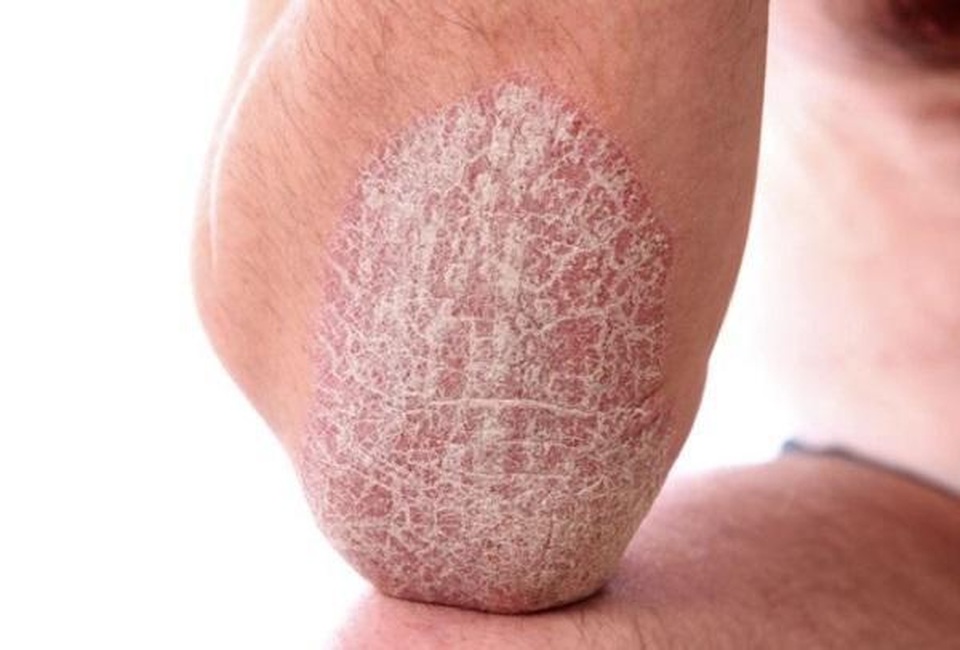 Bộ đôi sản phẩm Kim Miễn Khang và Explaq - Phương pháp độc đáo giúp cải thiện vảy nến hiệu quả, an toàn - 1 Bộ đôi sản phẩm Kim Miễn Khang và Explaq - Phương pháp độc đáo giúp cải thiện vảy nến hiệu quả, an toàn - 1