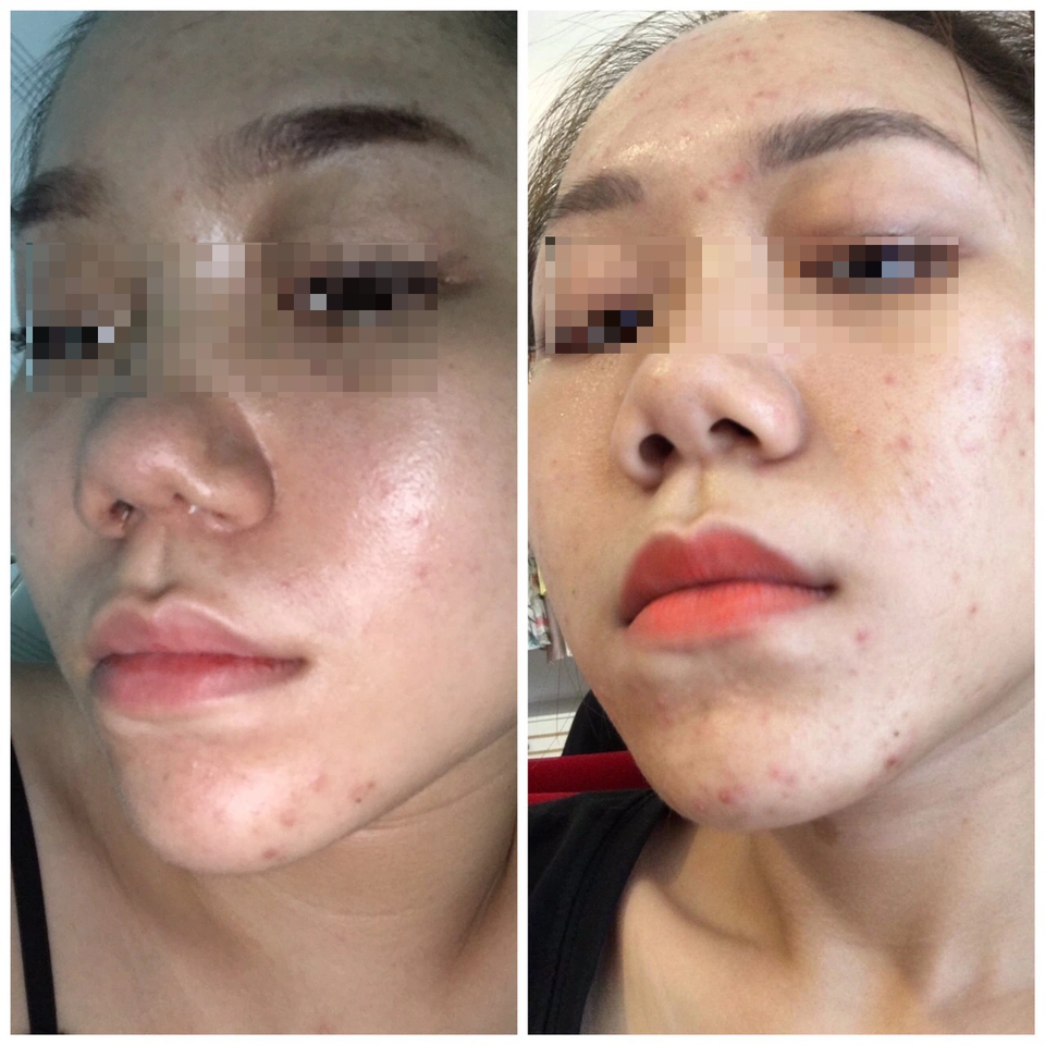 Phá sập mũi bệnh nhân, Thẩm mỹ Klain bị xử lý - 1 Phá sập mũi bệnh nhân, Thẩm mỹ Klain bị xử lý - 1