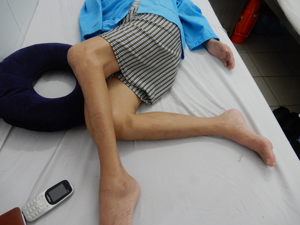 Người đàn ông bị cổng làng sập đè suýt chết, vợ đột quỵ khi chăm chồng - 5 Người đàn ông bị cổng làng sập đè suýt chết, vợ đột quỵ khi chăm chồng - 5