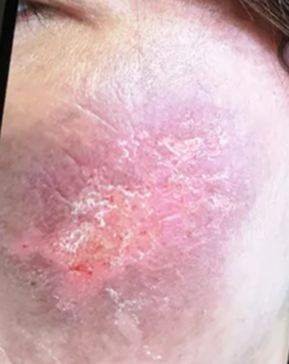 Má bị cày nát, thâm xì sau chữa nám tại spa - 2 Má bị cày nát, thâm xì sau chữa nám tại spa - 2