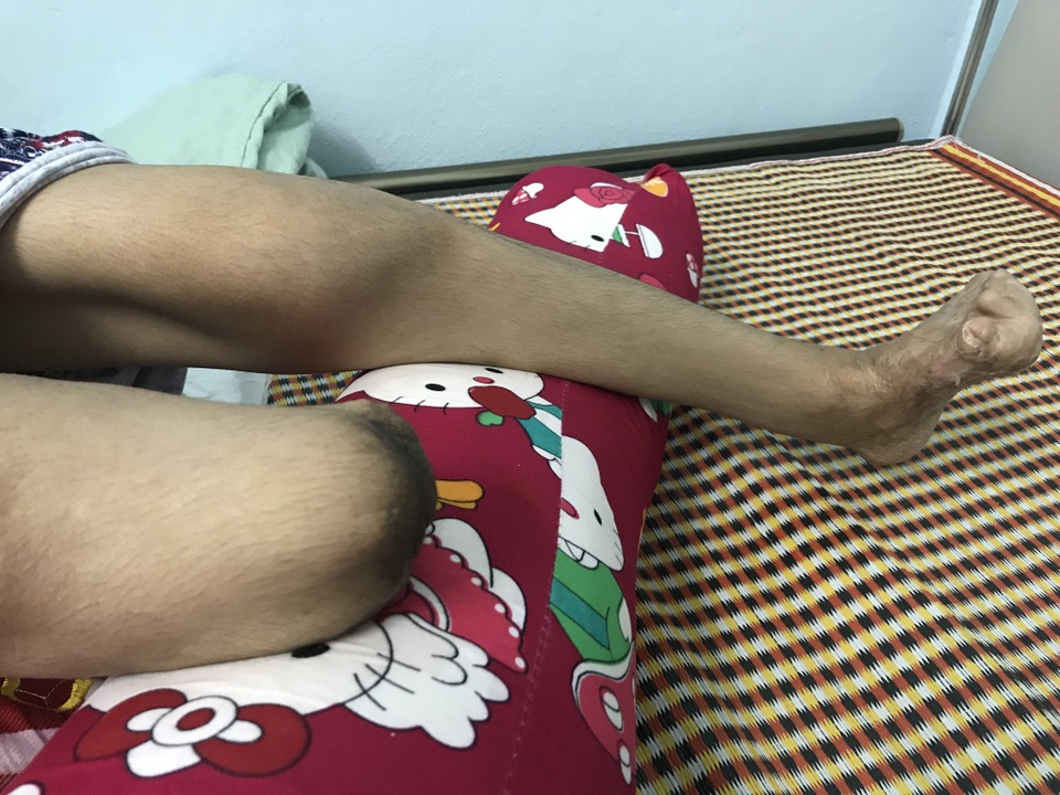 Người mẹ một chân khóc nghẹn ngào ước mơ trở về bên đứa con bé bỏng! - 3 Người mẹ một chân khóc nghẹn ngào ước mơ trở về bên đứa con bé bỏng! - 3