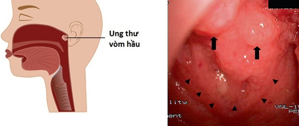 Những dấu hiệu dễ nhầm lẫn của ung thư vòm họng - 1 Những dấu hiệu dễ nhầm lẫn của ung thư vòm họng - 1