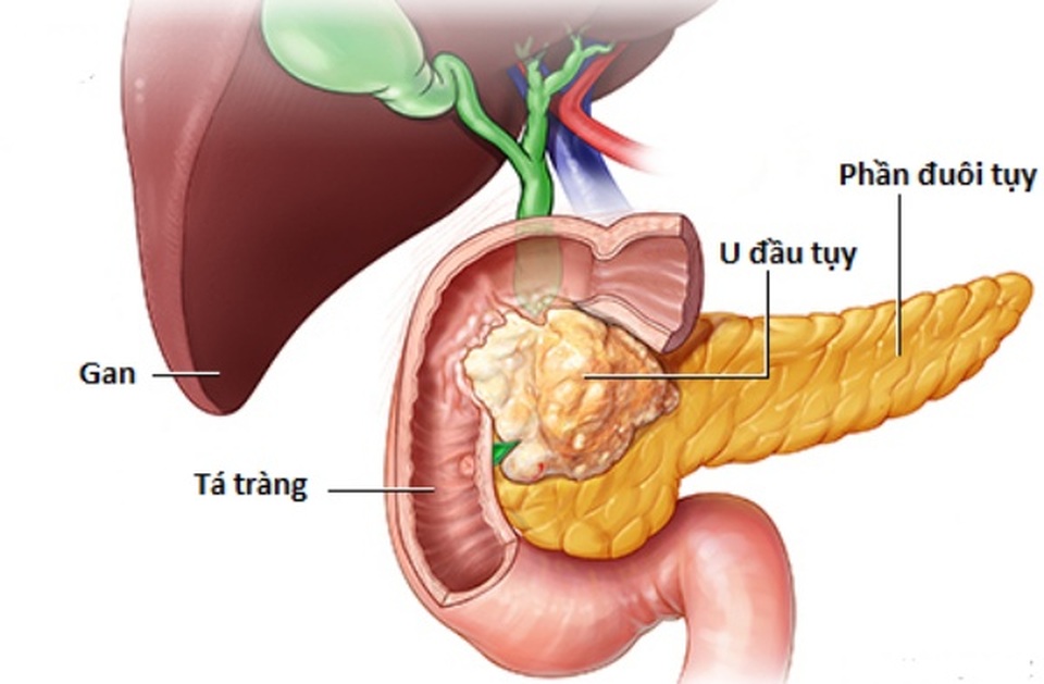 Dấu hiệu cảnh báo bệnh ung thư tuỵ - 1 Dấu hiệu cảnh báo bệnh ung thư tuỵ - 1