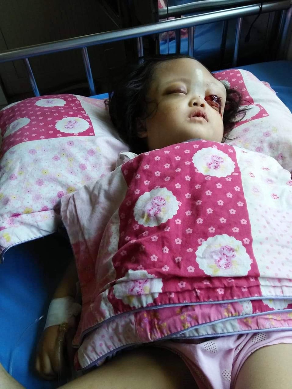 Nhìn bé gái bị ung thư hành hạ hỏng một mắt mà lòng tôi như quặn lại! - 2 Nhìn bé gái bị ung thư hành hạ hỏng một mắt mà lòng tôi như quặn lại! - 2