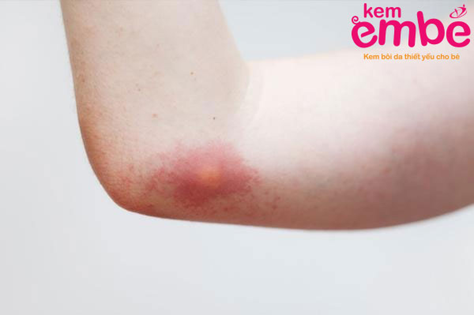 Bác sĩ da liễu cảnh báo 3 sai lầm nghiêm trọng 80% mẹ bỉm sữa mắc phải khi trẻ bị côn trùng cắn sưng đỏ - 1 Bác sĩ da liễu cảnh báo 3 sai lầm nghiêm trọng 80% mẹ bỉm sữa mắc phải khi trẻ bị côn trùng cắn sưng đỏ - 1