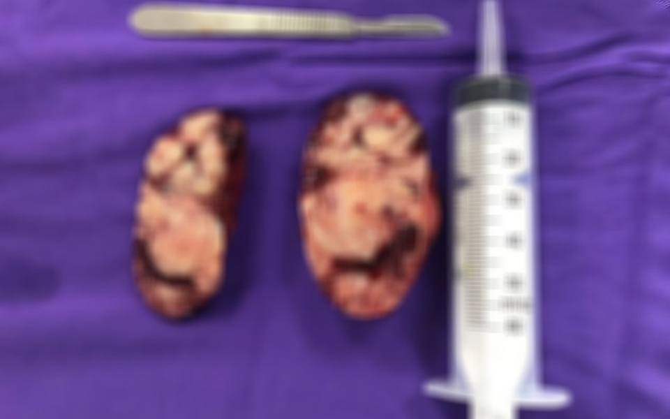 Bé 19 tháng bụng ngày một to lên vì khối u thượng thận - 1