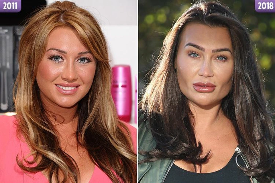 Fans khuyên Lauren Goodger dừng bơm môi - 3 Fans khuyên Lauren Goodger dừng bơm môi - 3