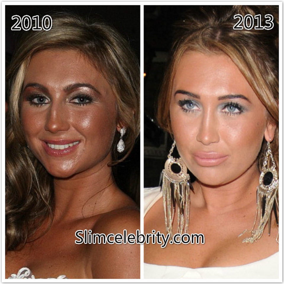 Fans khuyên Lauren Goodger dừng bơm môi - 5 Fans khuyên Lauren Goodger dừng bơm môi - 5