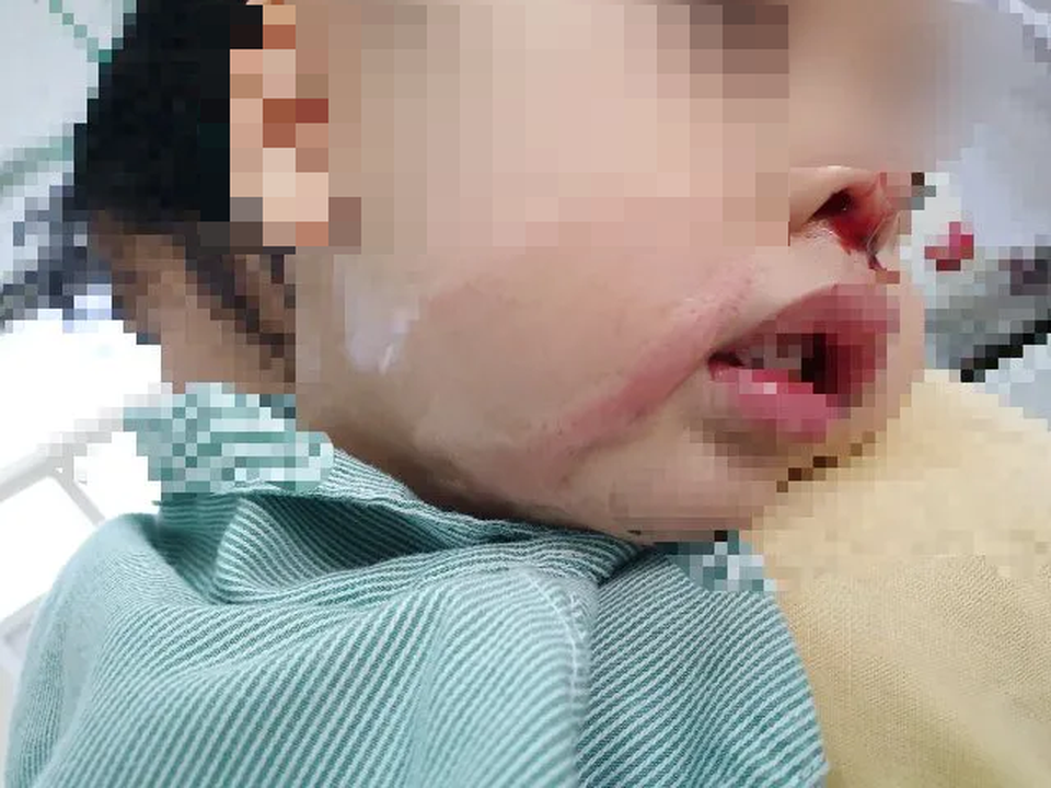Mẹ ngất xỉu vì nhầm lọ axit tẩy nốt ruồi là nước muối, nhỏ vào mũi con 4 tháng tuổi - 1 Mẹ ngất xỉu vì nhầm lọ axit tẩy nốt ruồi là nước muối, nhỏ vào mũi con 4 tháng tuổi - 1