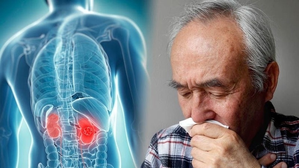 Bác sĩ khuyến cáo 5 điều cần làm để tránh xa căn bệnh ung thư thận - 1 Bác sĩ khuyến cáo 5 điều cần làm để tránh xa căn bệnh ung thư thận - 1
