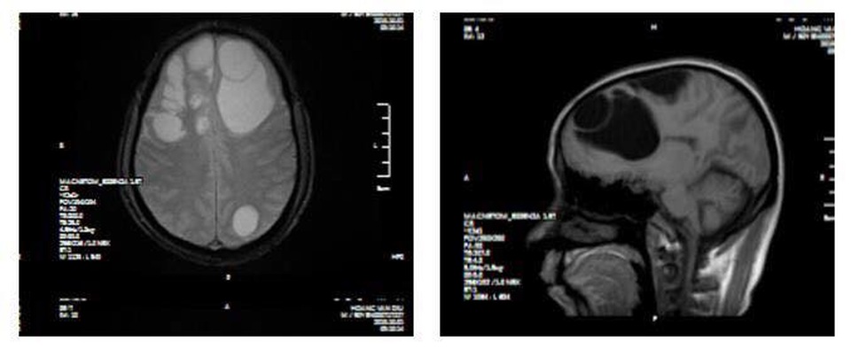 Hãi hùng ổ sán khổng lồ trú ngụ trong não người đàn ông - 1 Hãi hùng ổ sán khổng lồ trú ngụ trong não người đàn ông - 1