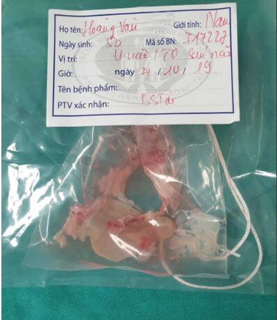 Hãi hùng ổ sán khổng lồ trú ngụ trong não người đàn ông - 2 Hãi hùng ổ sán khổng lồ trú ngụ trong não người đàn ông - 2