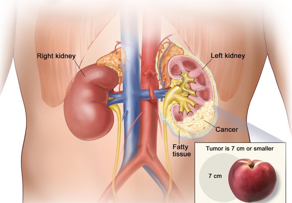 10 dấu hiệu cảnh báo ung thư thận không nên bỏ qua - 1