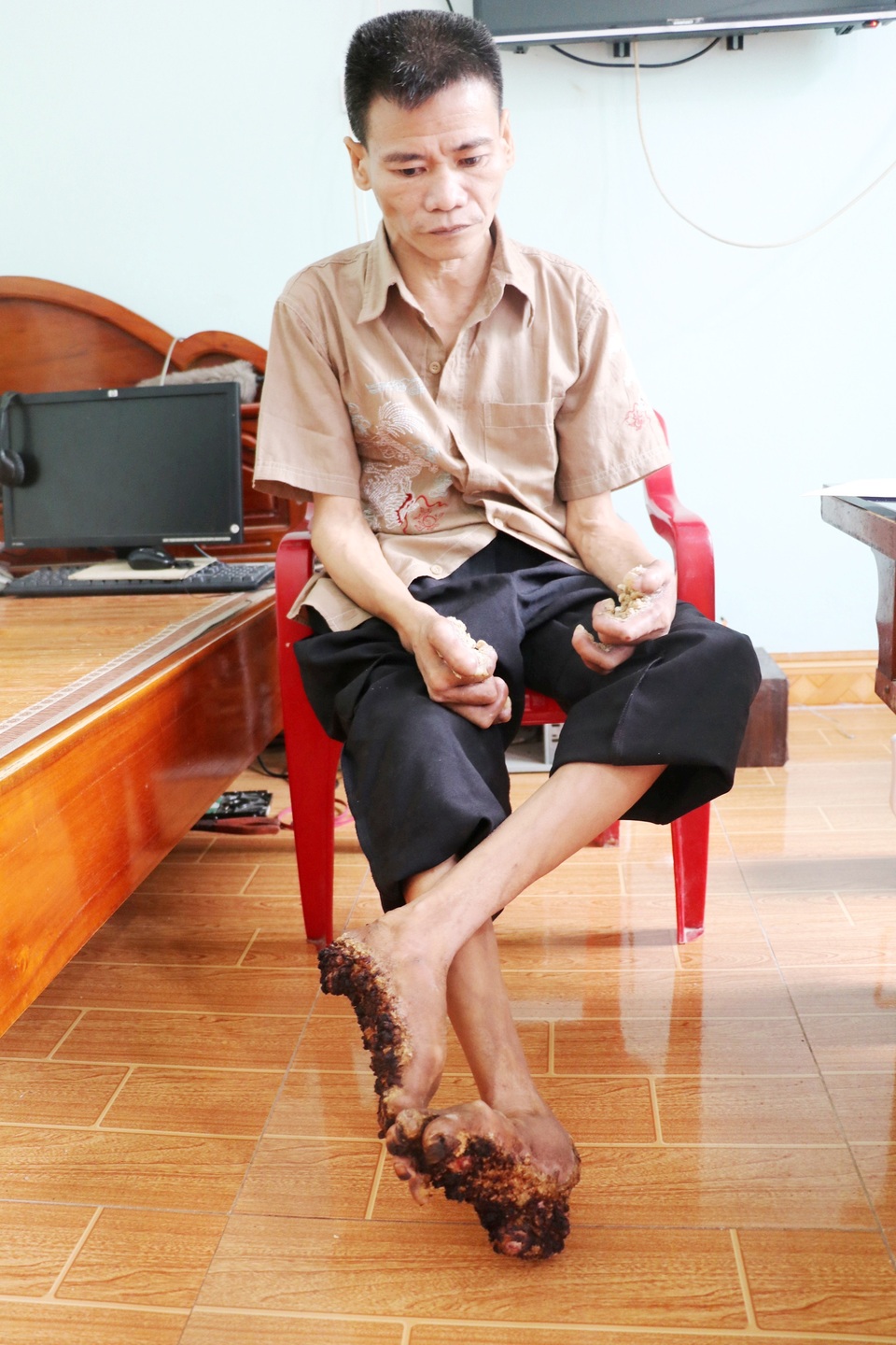 Thăm người đàn ông mang bệnh “người cây” ở Ninh Bình - 4 Thăm người đàn ông mang bệnh “người cây” ở Ninh Bình - 4