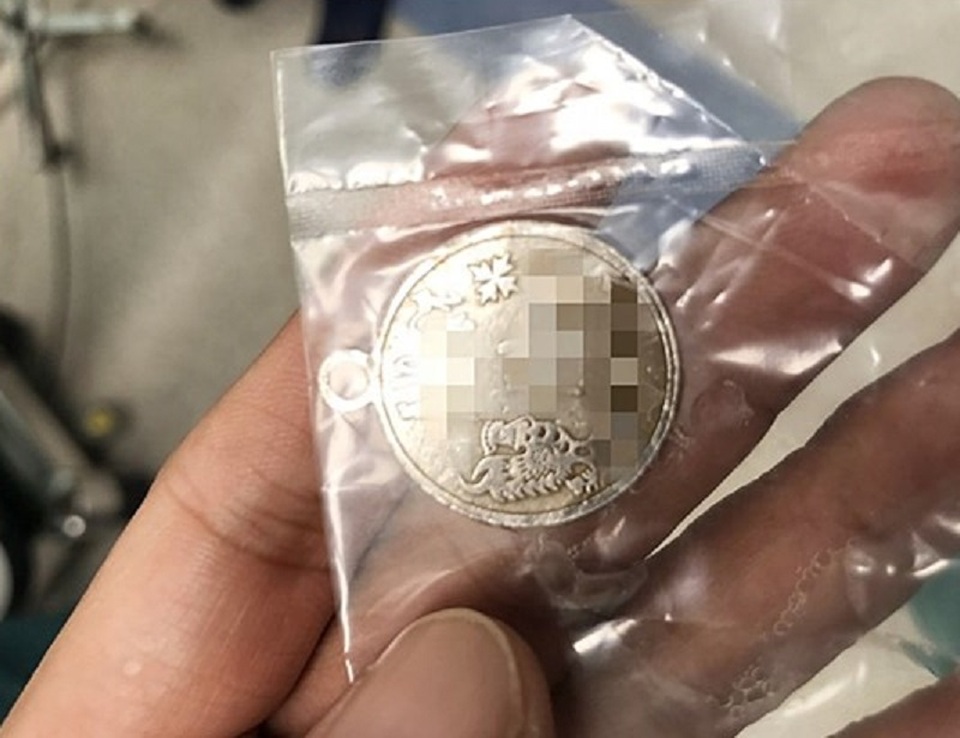 Mặt dây chuyền mắc ngang cổ họng, bé trai suýt tử vong - 2 Mặt dây chuyền mắc ngang cổ họng, bé trai suýt tử vong - 2