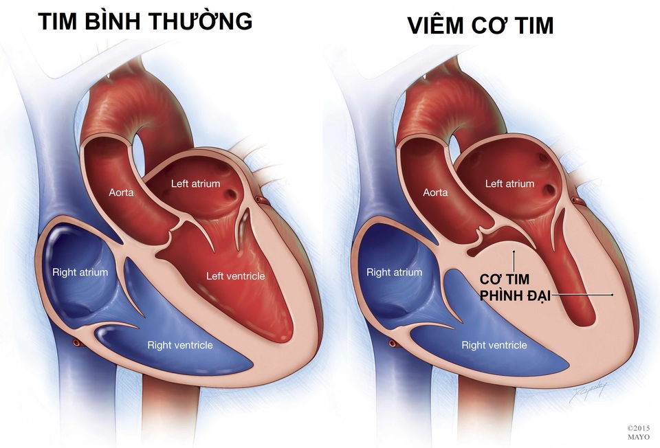 Viêm cơ tim ở trẻ em: Diễn biến thần tốc, có thể tử vong sau vài ngày - 1 Viêm cơ tim ở trẻ em: Diễn biến thần tốc, có thể tử vong sau vài ngày - 1