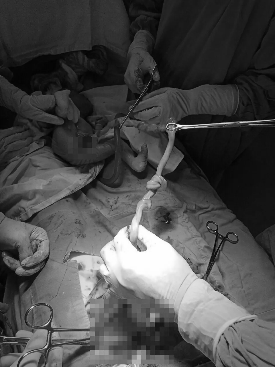 Bị dây rốn thắt nút hiếm gặp, 1 thai nhi suýt tử vong - 1 Bị dây rốn thắt nút hiếm gặp, 1 thai nhi suýt tử vong - 1