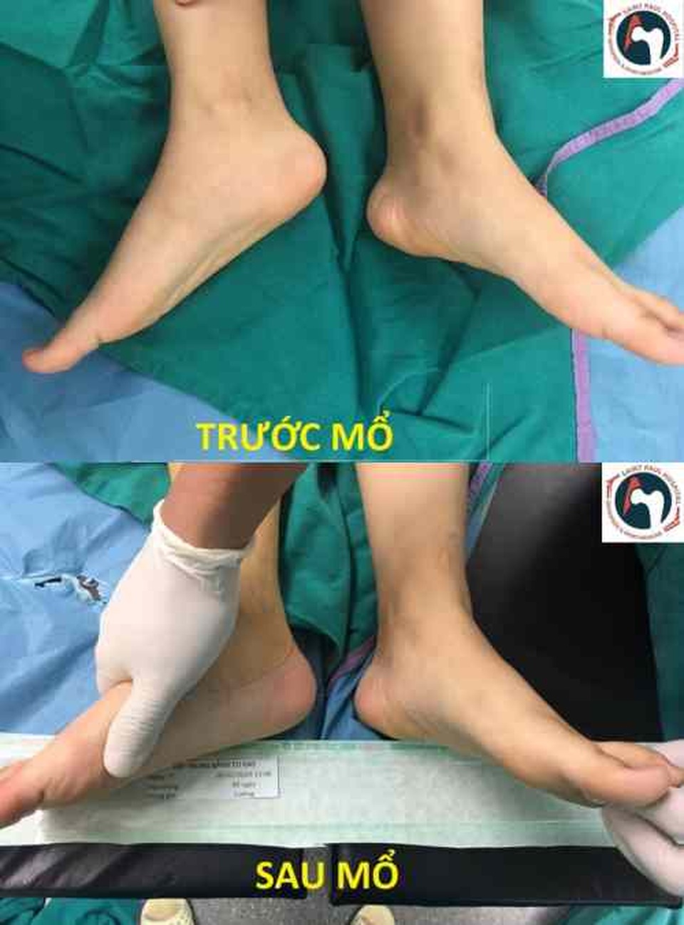 Nữ sinh lớp 9 suýt bị tàn tật vĩnh viễn vì căn bệnh tưởng chừng đơn giản - 3