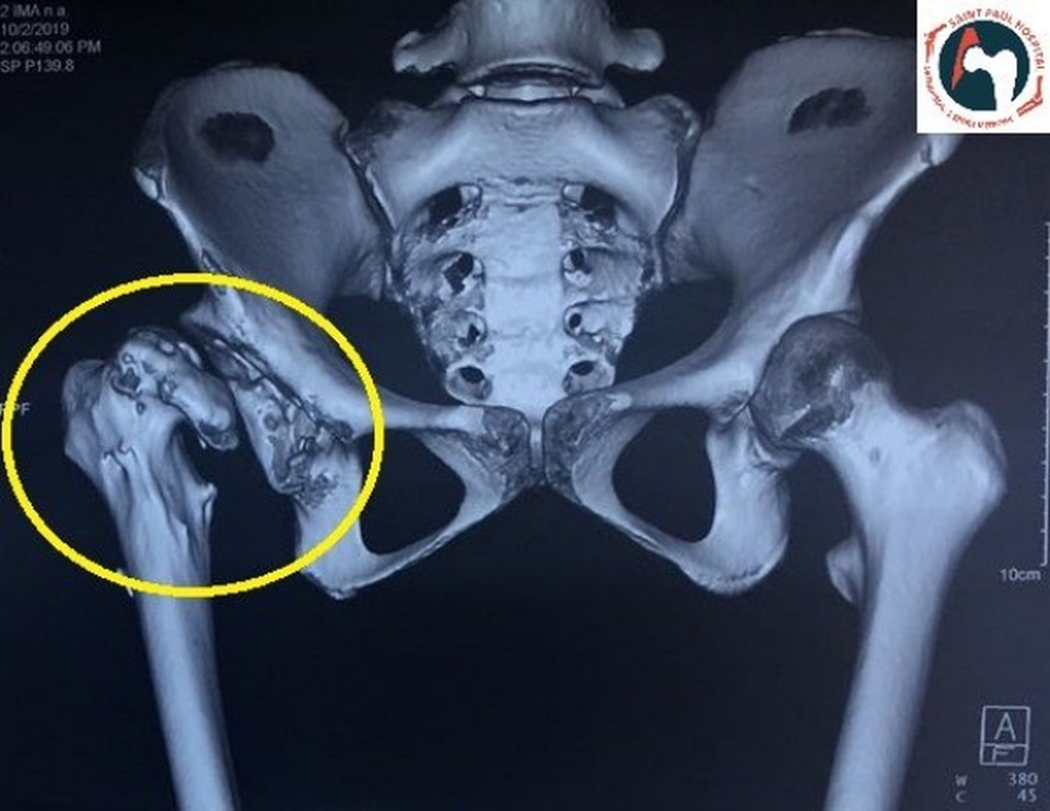 Nữ sinh lớp 9 suýt bị tàn tật vĩnh viễn vì căn bệnh tưởng chừng đơn giản - 1