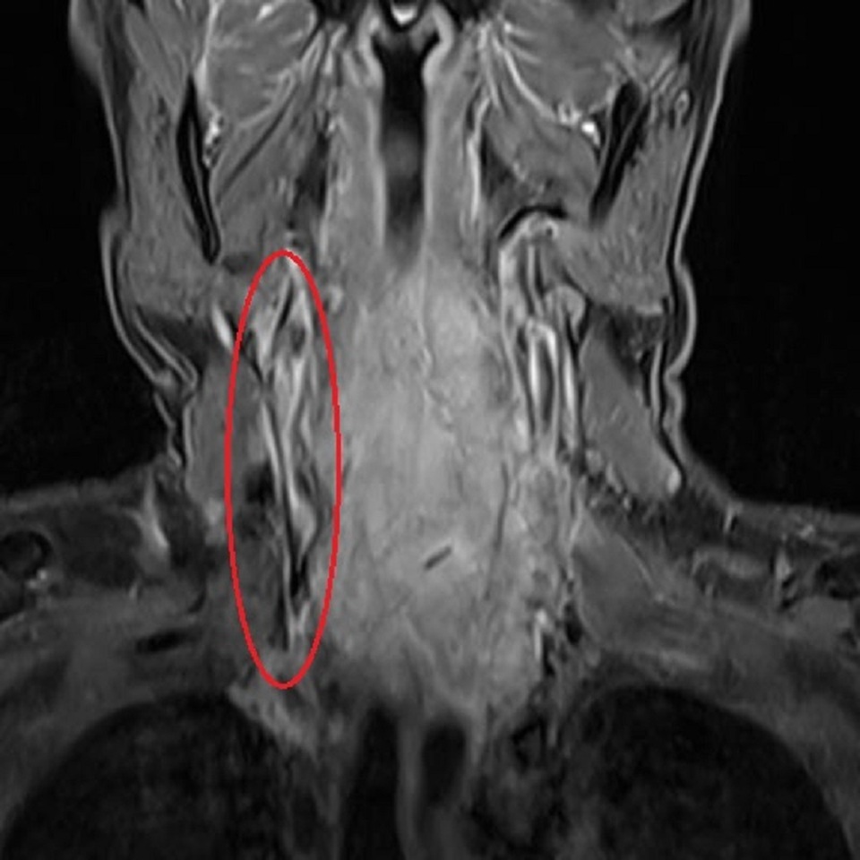 Cắt da, nặn máu trị thoái hóa đốt sống, bệnh nhân nhiễm khuẩn nguy kịch - 1 Cắt da, nặn máu trị thoái hóa đốt sống, bệnh nhân nhiễm khuẩn nguy kịch - 1