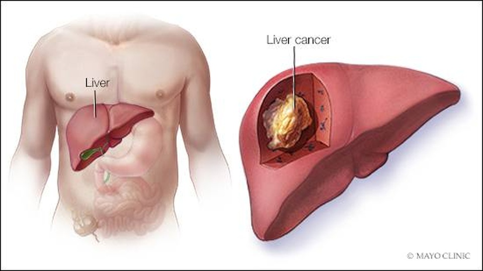 7 điều cần làm nếu muốn tránh ung thư gan - 1 7 điều cần làm nếu muốn tránh ung thư gan - 1