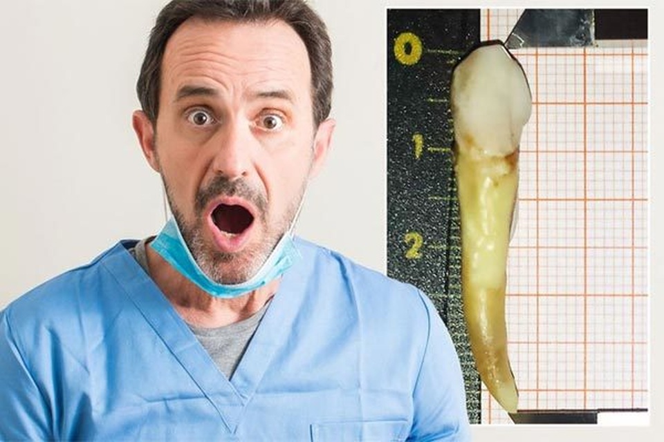 Lập kỷ lục thế giới nhờ chiếc răng dị thường - 3 Lập kỷ lục thế giới nhờ chiếc răng dị thường - 3
