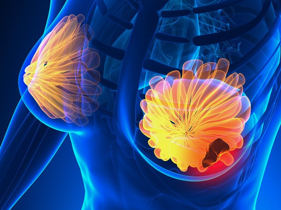 Phương pháp xét nghiệm máu mới giúp chẩn đoán ung thư vú trước 5 năm - 1 Phương pháp xét nghiệm máu mới giúp chẩn đoán ung thư vú trước 5 năm - 1