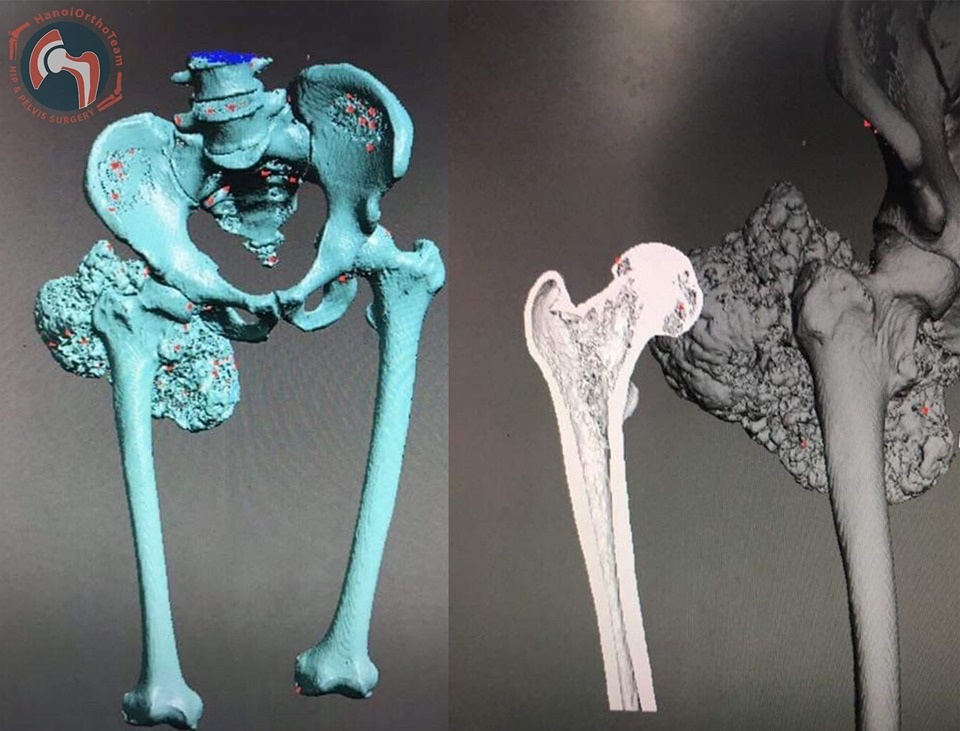 Lần đầu tiên ở Việt Nam: Xương đùi nhân tạo in 3D được ghép cho bệnh nhân - 1 Lần đầu tiên ở Việt Nam: Xương đùi nhân tạo in 3D được ghép cho bệnh nhân - 1
