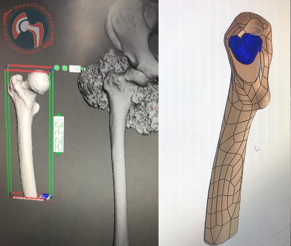 Lần đầu tiên ở Việt Nam: Xương đùi nhân tạo in 3D được ghép cho bệnh nhân - 2 Lần đầu tiên ở Việt Nam: Xương đùi nhân tạo in 3D được ghép cho bệnh nhân - 2