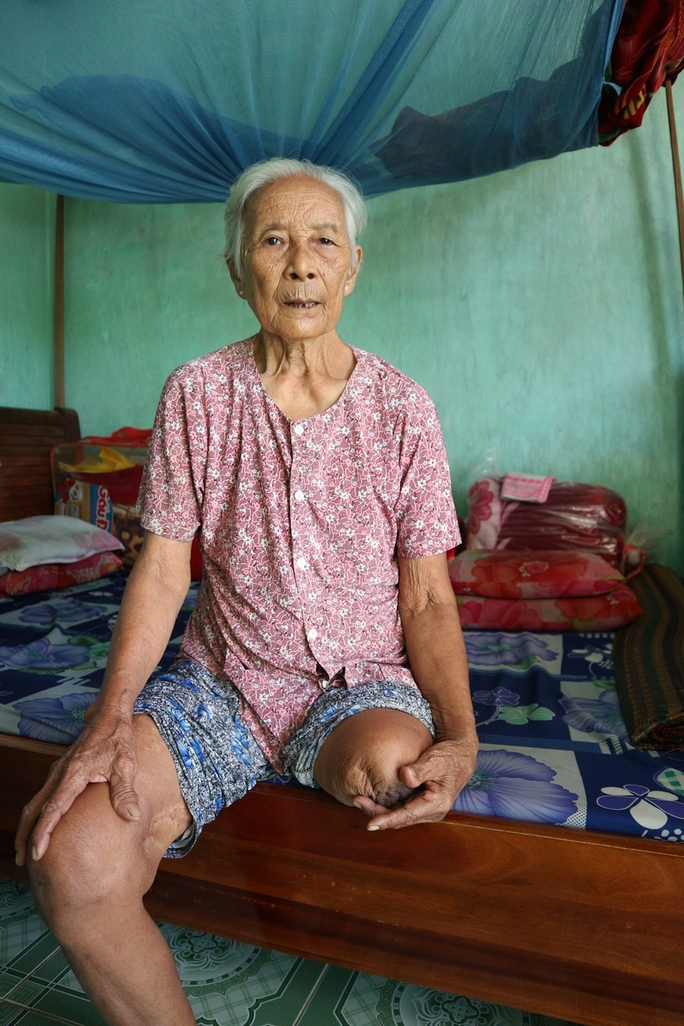Bà Tám bị đứt mất chân trái và đứt dây chằn chân phải do tai nạn lao động khiến việc đi lại, sinh hoạt khá khó khăn Xót xa cảnh chồng mù vợ cụt chân sống “vật vờ” bên người con trai tâm thần
