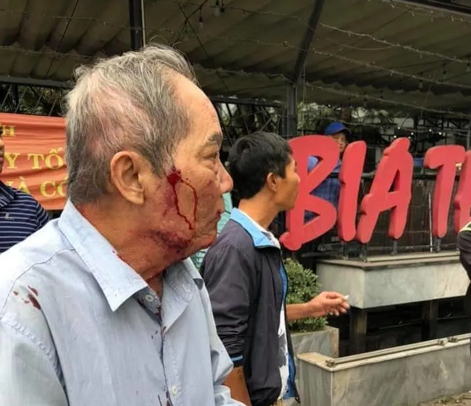 Hà Nội: Điều tra vụ cụ ông 80 tuổi chạy xe ôm bị đánh đến nhập viện - 1 Hà Nội: Điều tra vụ cụ ông 80 tuổi chạy xe ôm bị đánh đến nhập viện - 1