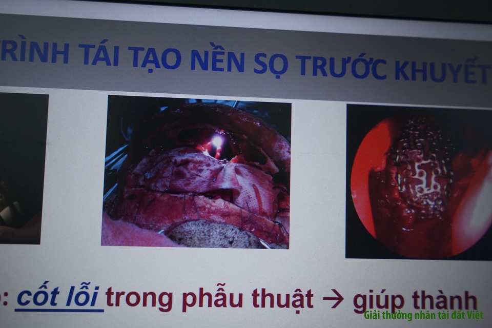 BV Chợ Rẫy: Phương pháp phẫu thuật 3 trong 1 giúp người bệnh thoát “án tử” - 8 BV Chợ Rẫy: Phương pháp phẫu thuật 3 trong 1 giúp người bệnh thoát “án tử” - 8