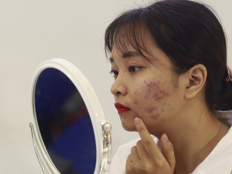 Dr. Huệ - địa chỉ trị mụn uy tín giá phải chăng cho sinh viên tại TP.HCM - 1 Dr. Huệ - địa chỉ trị mụn uy tín giá phải chăng cho sinh viên tại TP.HCM - 1