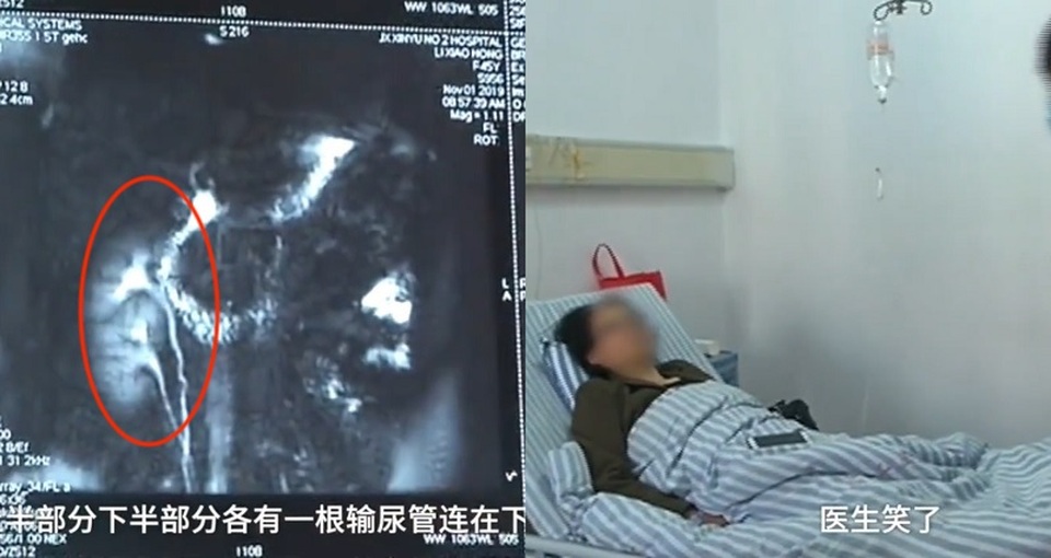 Phát hiện có 3 quả thận, đồng ý cho bớt 1 quả - 1 Phát hiện có 3 quả thận, đồng ý cho bớt 1 quả - 1