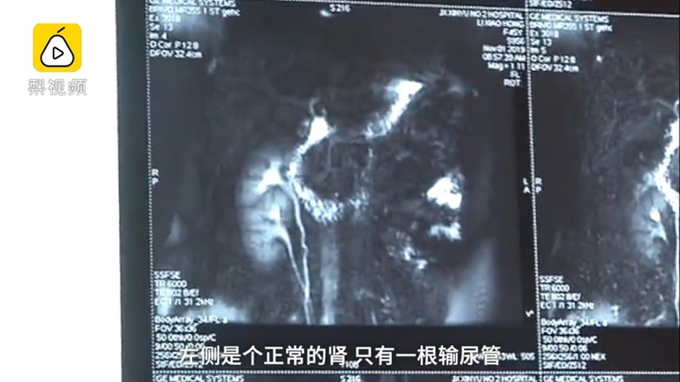 Phát hiện có 3 quả thận, đồng ý cho bớt 1 quả - 3 Phát hiện có 3 quả thận, đồng ý cho bớt 1 quả - 3