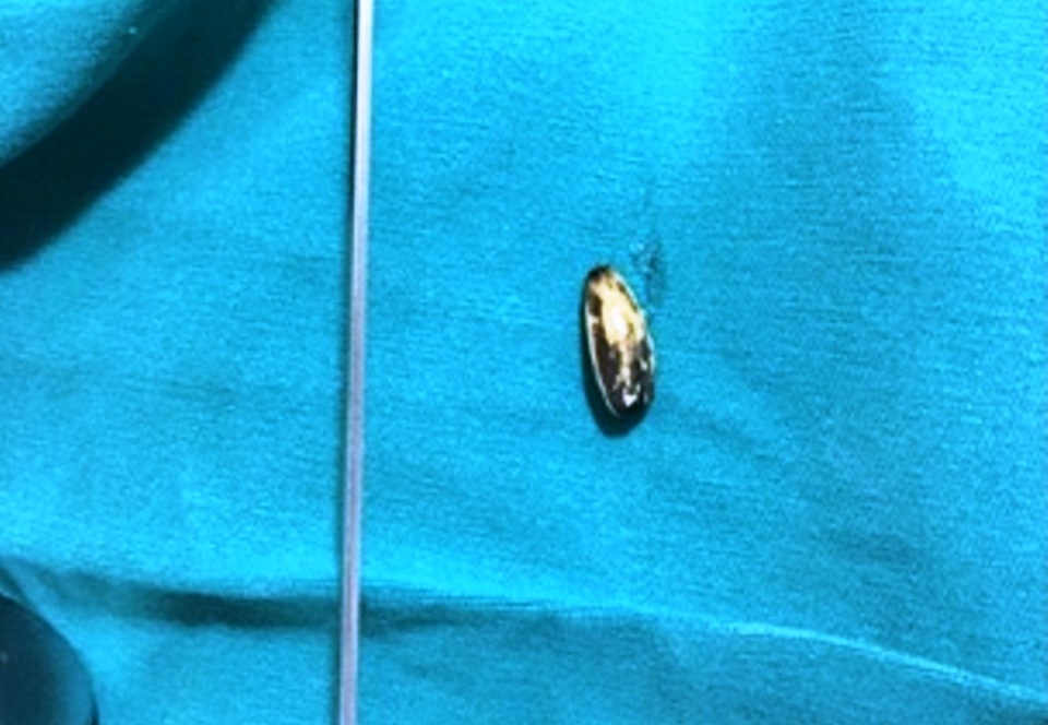 Bé trai 17 tháng tuổi bị hạt hướng dương che gần hết đường thở - 2