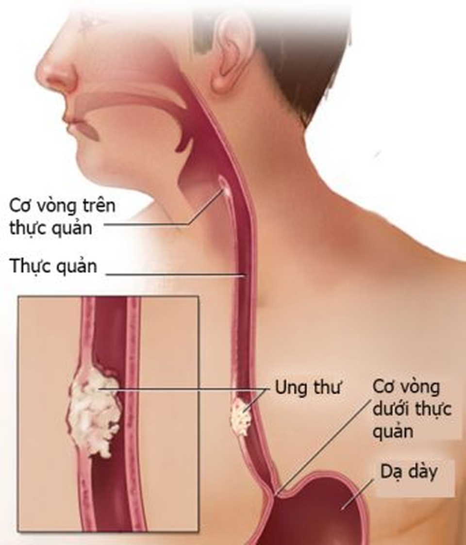 Thói quen làm tăng 10 lần nguy cơ mắc ung thư thực quản nhiều quý ông vẫn không từ bỏ - 2 Thói quen làm tăng 10 lần nguy cơ mắc ung thư thực quản nhiều quý ông vẫn không từ bỏ - 2