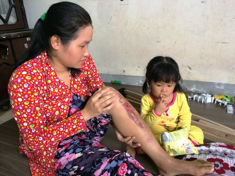 Khổ cảnh vợ chống nạng thăm chồng bị điện giật cháy khét 2 chân - 2
Vừa rồi chị Âu bị té trong nhà tắm, chỗ cái chân gãy đỏ bầm lên... Chị rất lo chẳng biết có bị gì không?