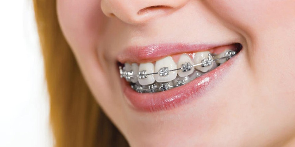 Lý do nhiều người Việt tốn hàng chục triệu niềng răng nhưng vẫn hỏng - 2 Lý do nhiều người Việt tốn hàng chục triệu niềng răng nhưng vẫn hỏng - 2
