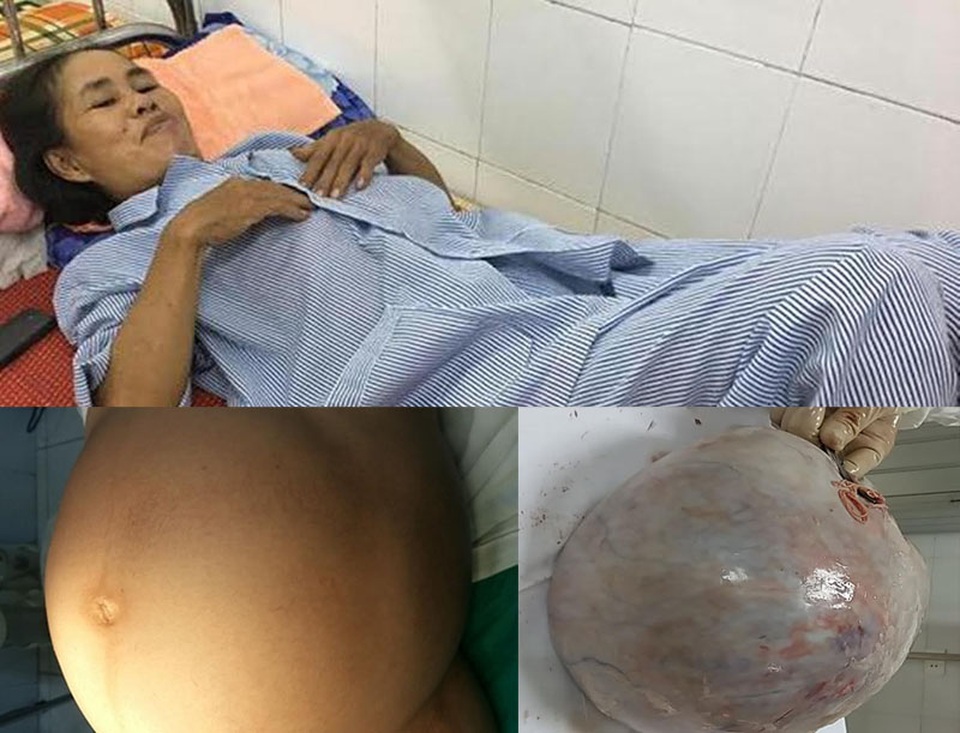 Nghe lời thầy bói, “mang thai” khối u 10kg suốt 9 tháng - 1 Bệnh nhân Nguyễn Thị Chiên đã được các bác sĩ phẫu thuật thành công khối u nặng 10kg