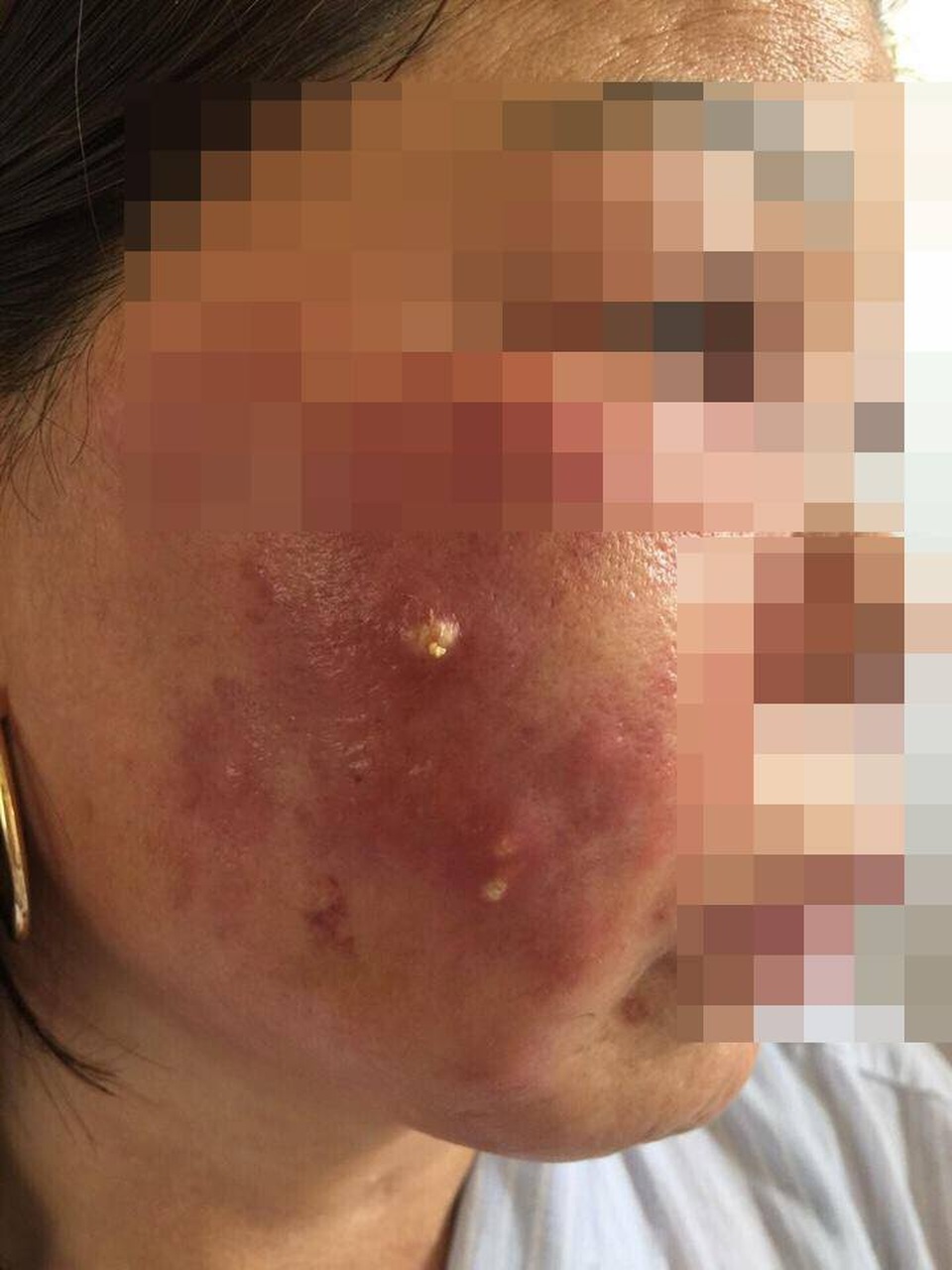 Hai mẹ con mặt mũi sưng vù, khó thở vì tiêm làm trắng da - 1 Hai mẹ con mặt mũi sưng vù, khó thở vì tiêm làm trắng da - 1